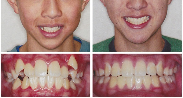 dental implant dentist ft worth