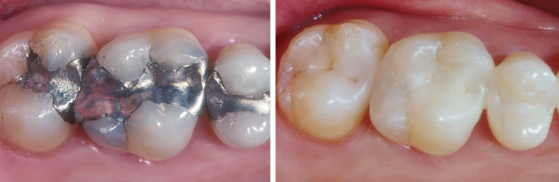 fort worth dental implants